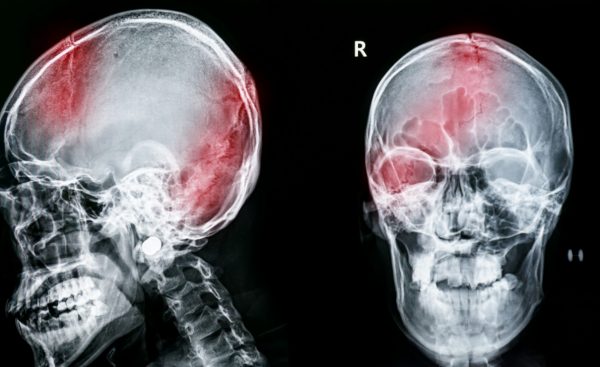 Traumatic Brain Injury Attorneys In Myrtle Beach